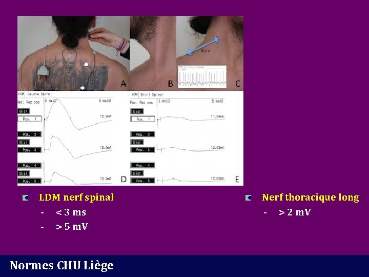 LDM nerf spinal - < 3 ms - > 5 m. V Normes CHU