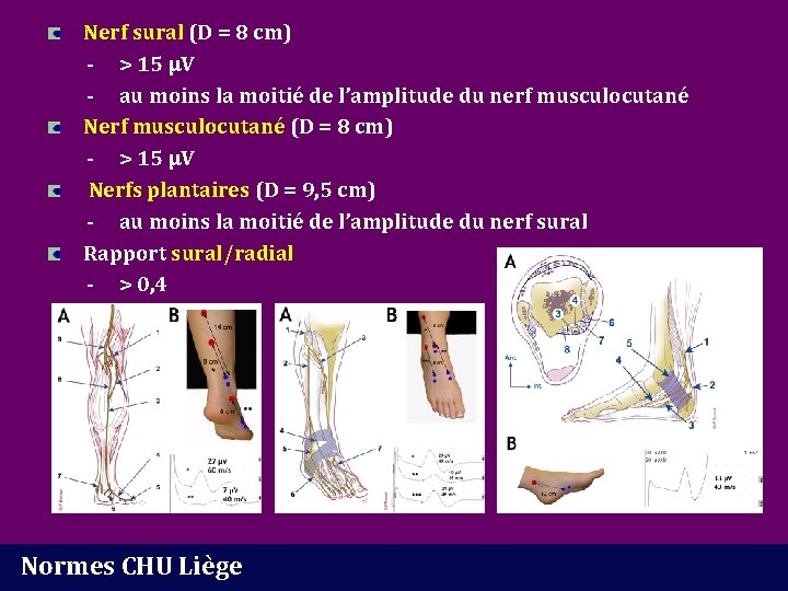 Nerf sural (D = 8 cm) - > 15 µV - au moins la