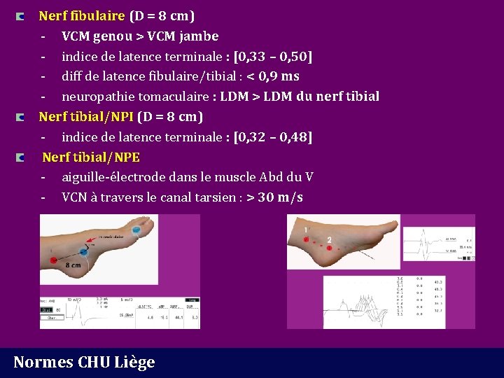 Nerf fibulaire (D = 8 cm) - VCM genou > VCM jambe - indice