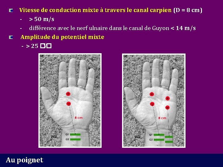 Vitesse de conduction mixte à travers le canal carpien (D = 8 cm) -