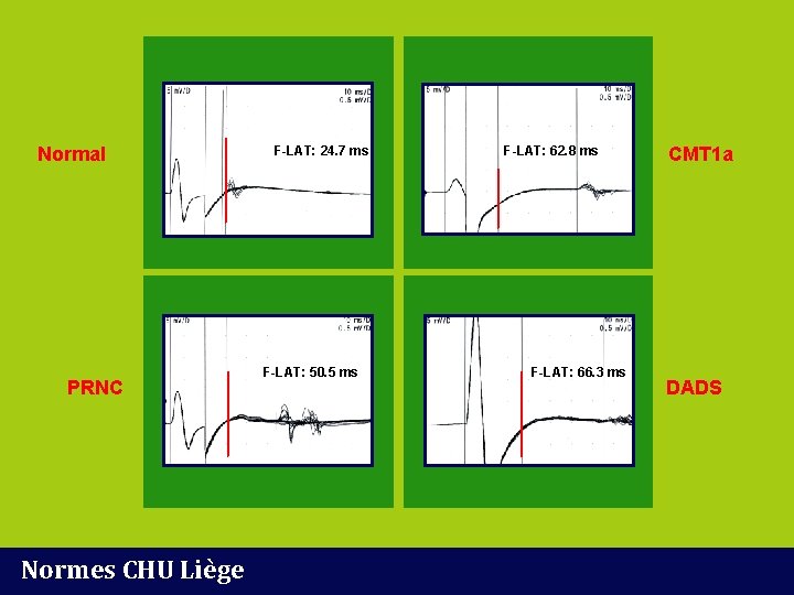 Normal PRNC Normes CHU Liège F-LAT: 24. 7 ms F-LAT: 50. 5 ms F-LAT: