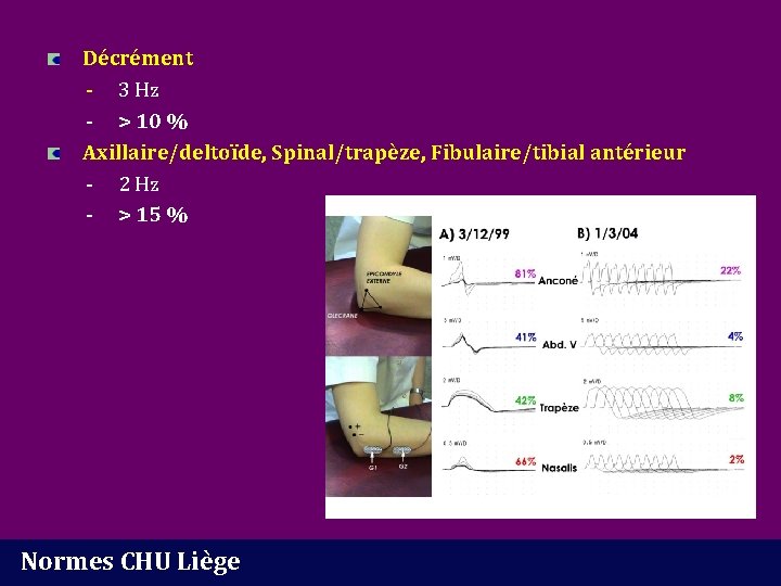 Décrément - 3 Hz - > 10 % Axillaire/deltoïde, Spinal/trapèze, Fibulaire/tibial antérieur - 2