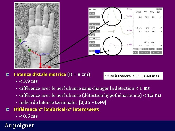 Latence distale motrice (D = 8 cm) VCM à travers le CC : >