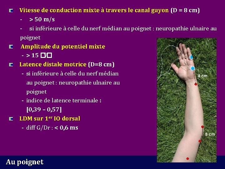 Vitesse de conduction mixte à travers le canal guyon (D = 8 cm) -