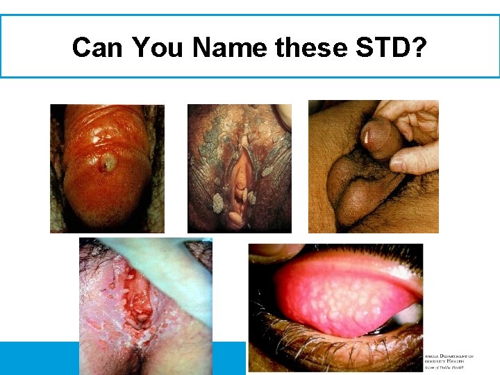 Can You Name these STD? 
