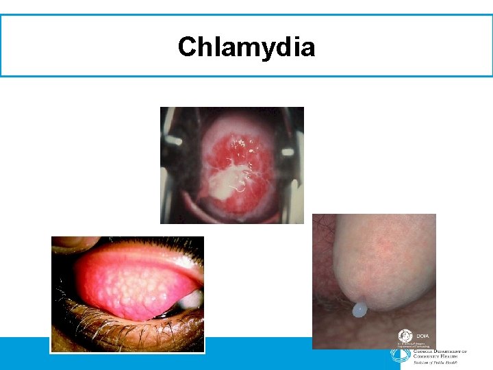 Chlamydia 