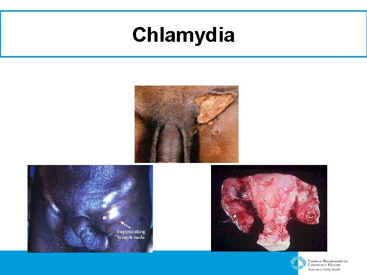 Chlamydia 