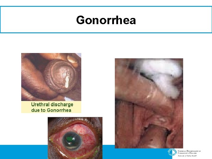 Gonorrhea 