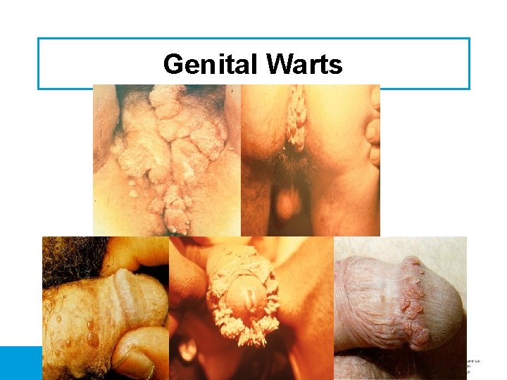 Genital Warts 
