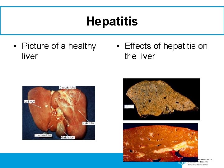 Hepatitis • Picture of a healthy liver • Effects of hepatitis on the liver