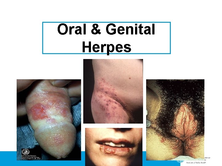 Oral & Genital Herpes 