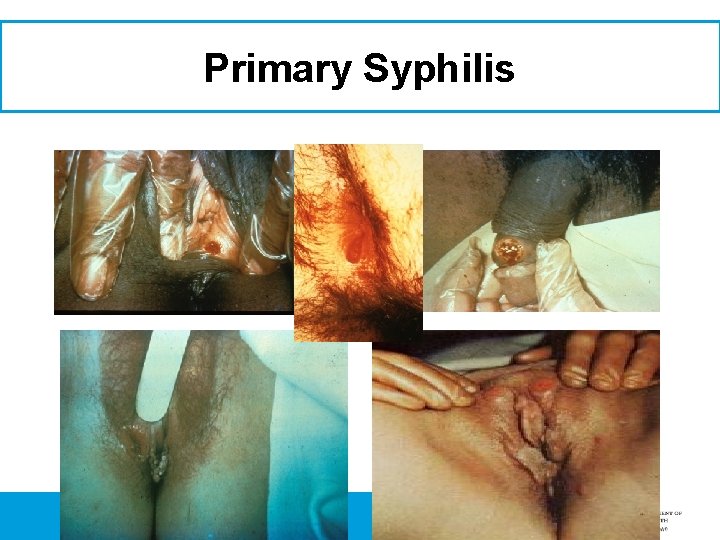 Primary Syphilis 