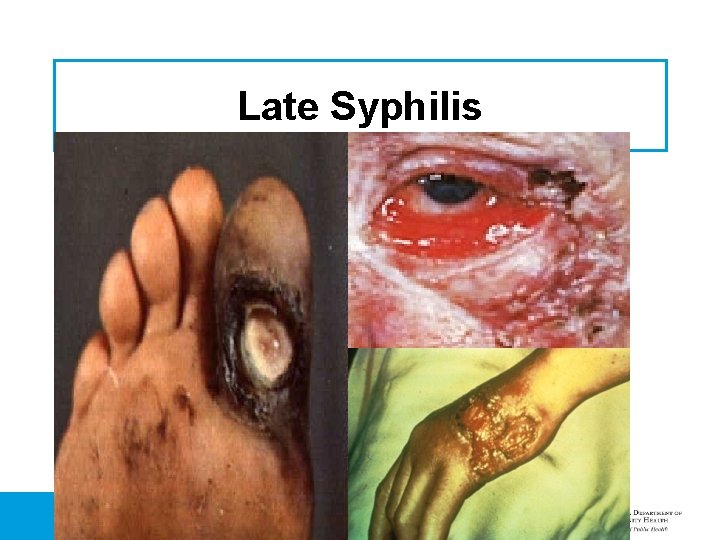 Late Syphilis 
