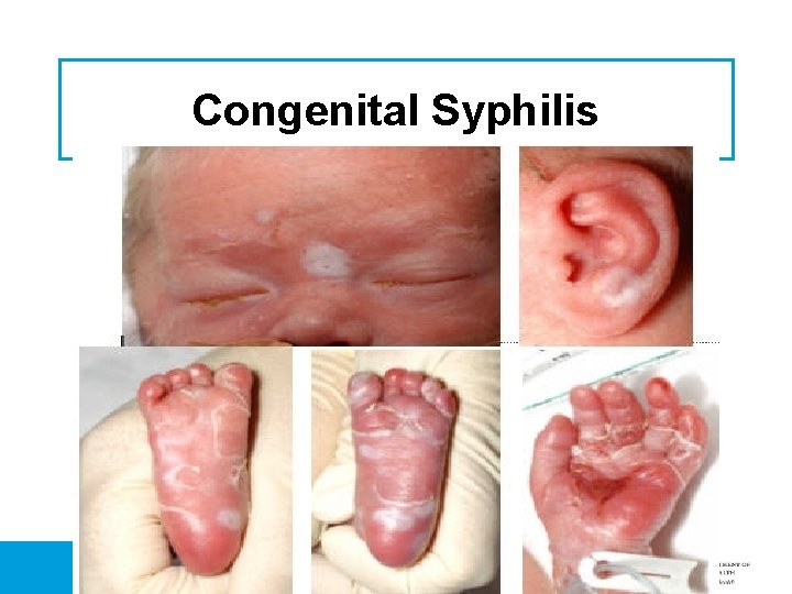 Congenital Syphilis 