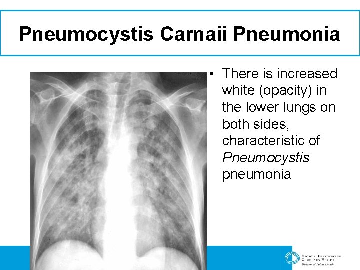 Pneumocystis Carnaii Pneumonia • There is increased white (opacity) in the lower lungs on