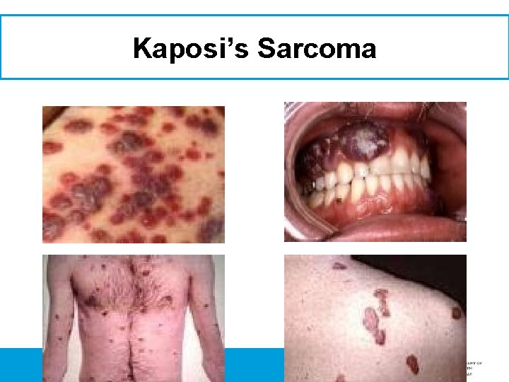 Kaposi’s Sarcoma 