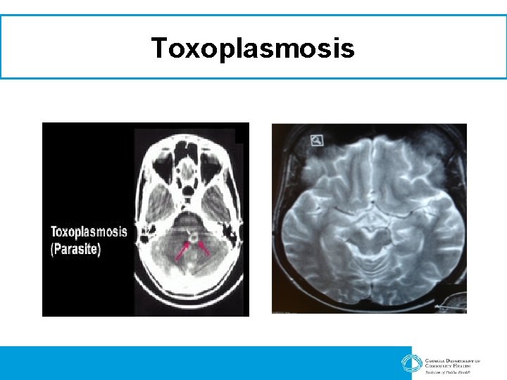 Toxoplasmosis 