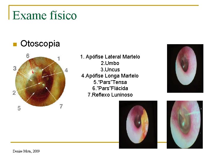 Exame físico n Otoscopia 1. Apófise Lateral Martelo 2. Umbo 3. Uncus 4. Apófise