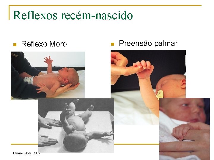 Reflexos recém-nascido n Reflexo Moro Denise Mota, 2009 n Preensão palmar 