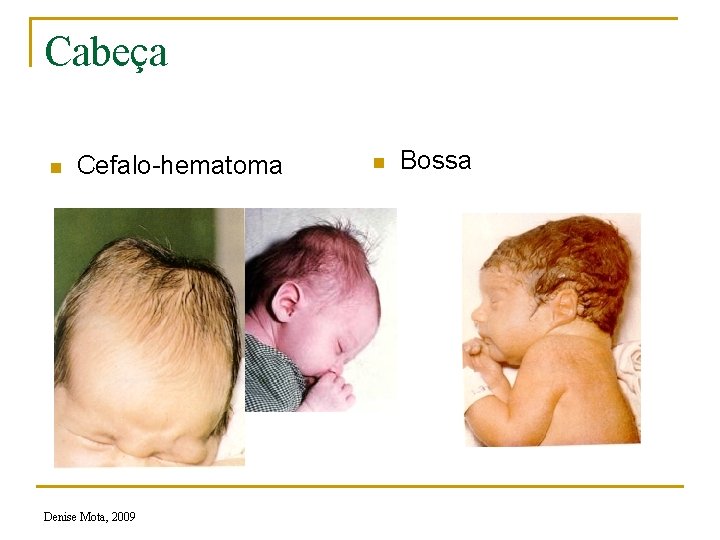 Cabeça n Cefalo-hematoma Denise Mota, 2009 n Bossa 
