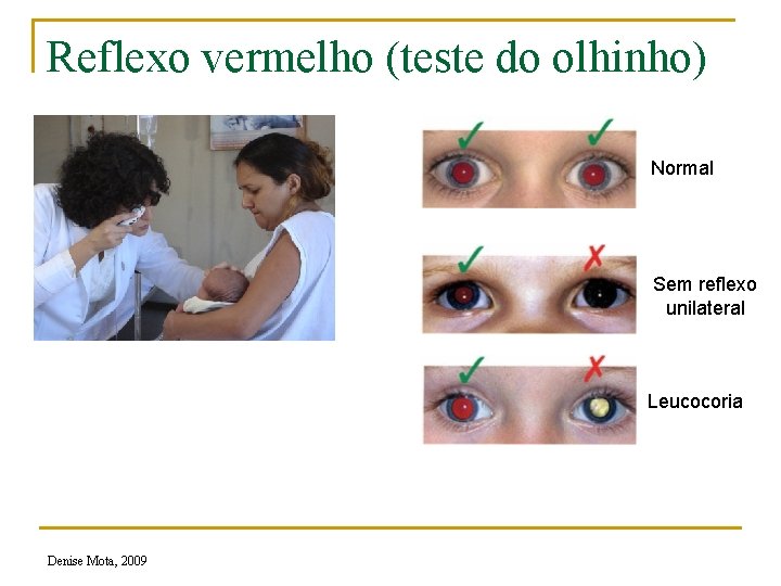 Reflexo vermelho (teste do olhinho) Normal Sem reflexo unilateral Leucocoria Denise Mota, 2009 