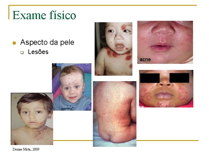 Exame físico n Aspecto da pele q Lesões acne Denise Mota, 2009 