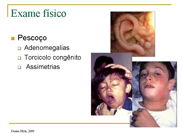 Exame físico n Pescoço q q q Adenomegalias Torcicolo congênito Assimetrias Denise Mota, 2009