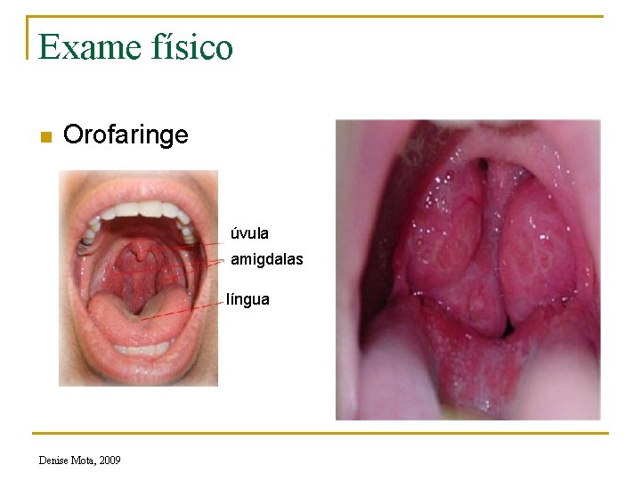 Exame físico n Orofaringe úvula amigdalas língua Denise Mota, 2009 