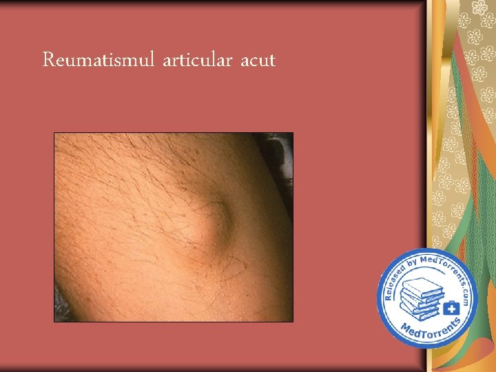 Reumatismul articular acut 