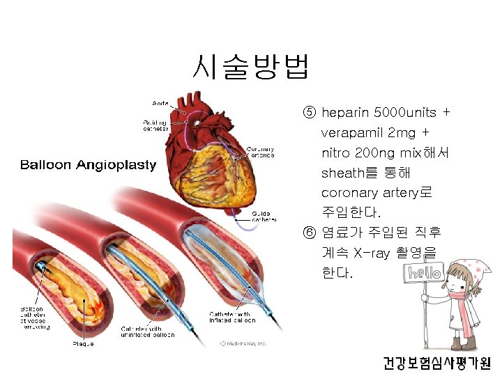 시술방법 ⑤ heparin 5000 units + verapamil 2 mg + nitro 200 ng mix해서