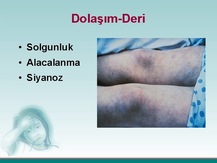 Dolaşım-Deri • Solgunluk • Alacalanma • Siyanoz 