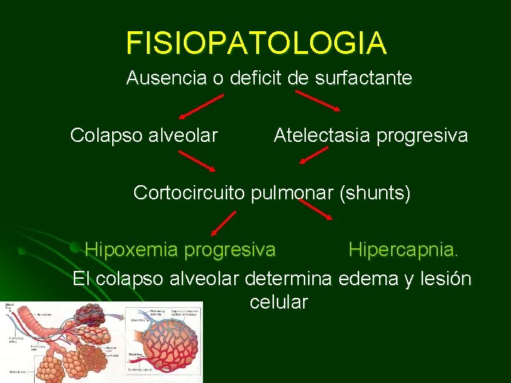 FISIOPATOLOGIA Ausencia o deficit de surfactante Colapso alveolar Atelectasia progresiva Cortocircuito pulmonar (shunts) Hipoxemia