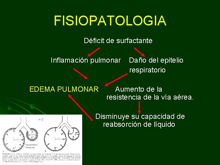 FISIOPATOLOGIA Déficit de surfactante Inflamación pulmonar Daño del epitelio respiratorio EDEMA PULMONAR Aumento de