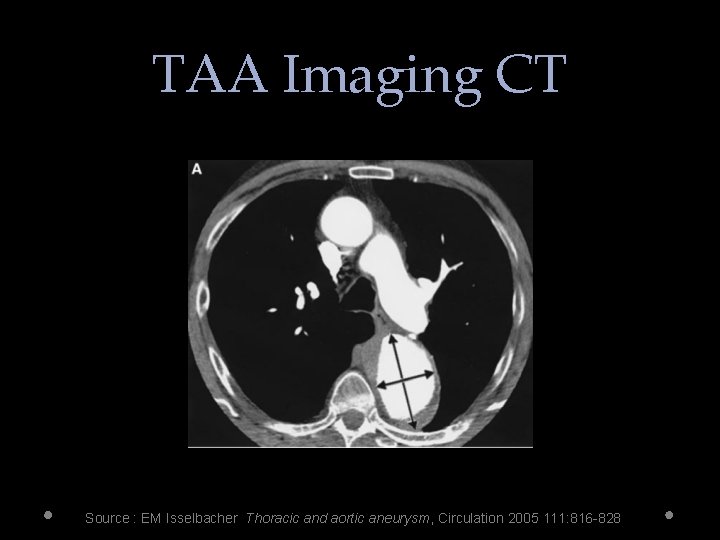 TAA Imaging CT Source : EM Isselbacher Thoracic and aortic aneurysm, Circulation 2005 111: