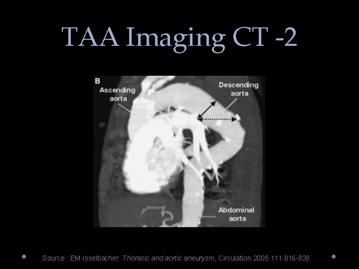 TAA Imaging CT -2 Source : EM Isselbacher Thoracic and aortic aneurysm, Circulation 2005