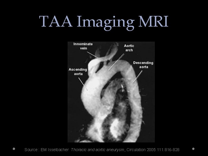 TAA Imaging MRI Source : EM Isselbacher Thoracic and aortic aneurysm, Circulation 2005 111: