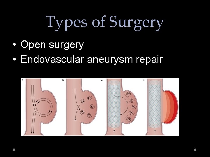 Types of Surgery • Open surgery • Endovascular aneurysm repair 