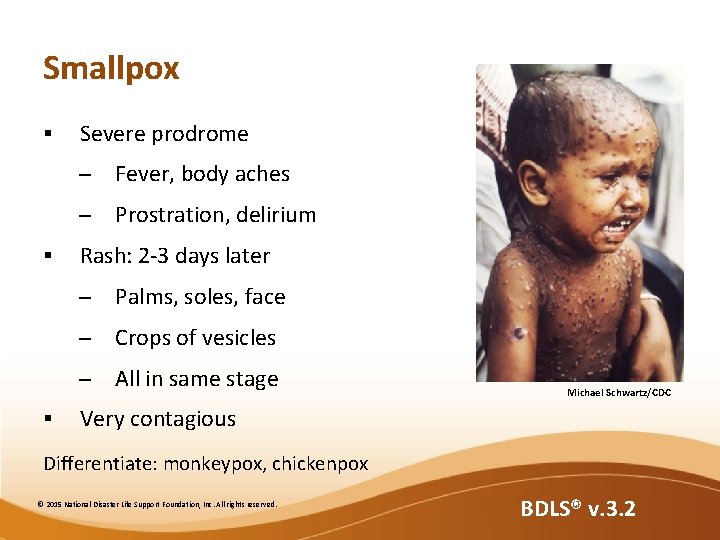 Smallpox § § § Severe prodrome – Fever, body aches – Prostration, delirium Rash: Smallpox § § § Severe prodrome – Fever, body aches – Prostration, delirium Rash: