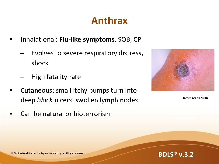 Anthrax § § § Inhalational: Flu-like symptoms, SOB, CP – Evolves to severe respiratory Anthrax § § § Inhalational: Flu-like symptoms, SOB, CP – Evolves to severe respiratory