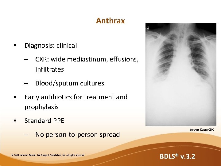Anthrax § Diagnosis: clinical – CXR: wide mediastinum, effusions, infiltrates – Blood/sputum cultures § Anthrax § Diagnosis: clinical – CXR: wide mediastinum, effusions, infiltrates – Blood/sputum cultures §