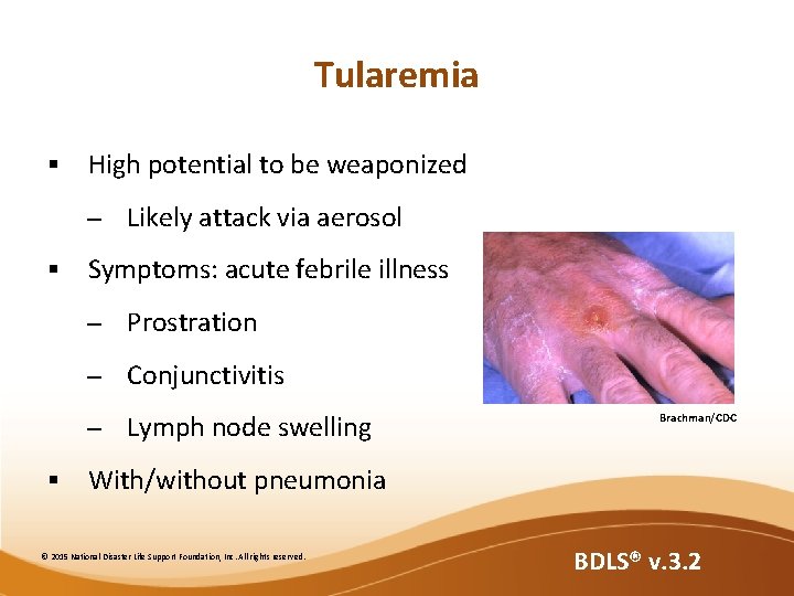Tularemia § High potential to be weaponized – § § Likely attack via aerosol Tularemia § High potential to be weaponized – § § Likely attack via aerosol