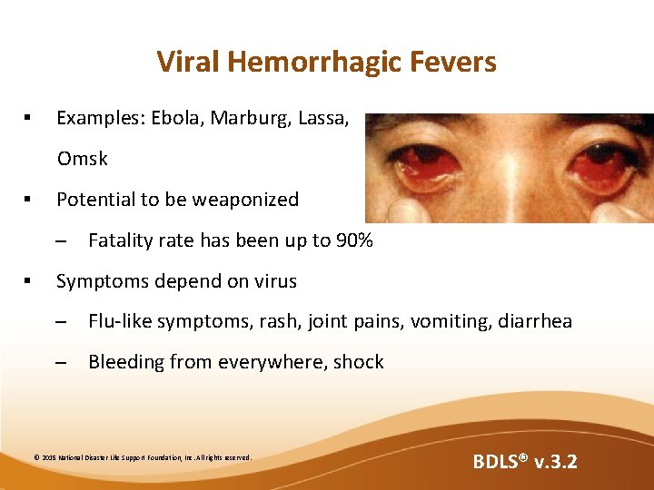 Viral Hemorrhagic Fevers § Examples: Ebola, Marburg, Lassa, Omsk § Potential to be weaponized Viral Hemorrhagic Fevers § Examples: Ebola, Marburg, Lassa, Omsk § Potential to be weaponized