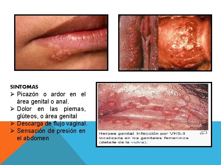 SINTOMAS Ø Picazón o ardor en el área genital o anal. Ø Dolor en