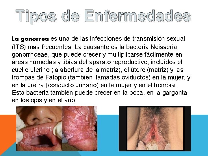 Tipos de Enfermedades La gonorrea es una de las infecciones de transmisión sexual (ITS)