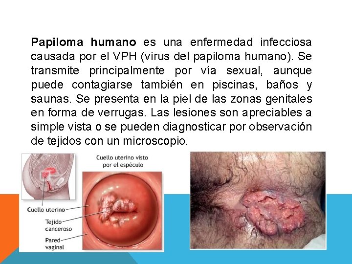 Papiloma humano es una enfermedad infecciosa causada por el VPH (virus del papiloma humano).