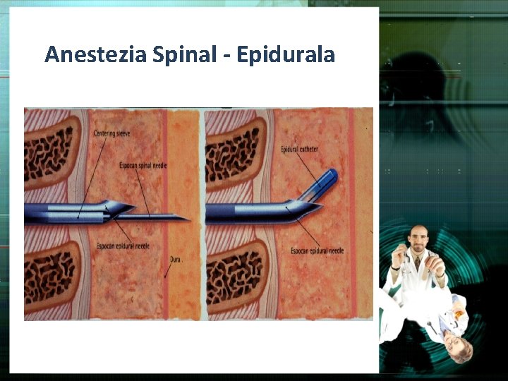 Anestezia Spinal - Epidurala 