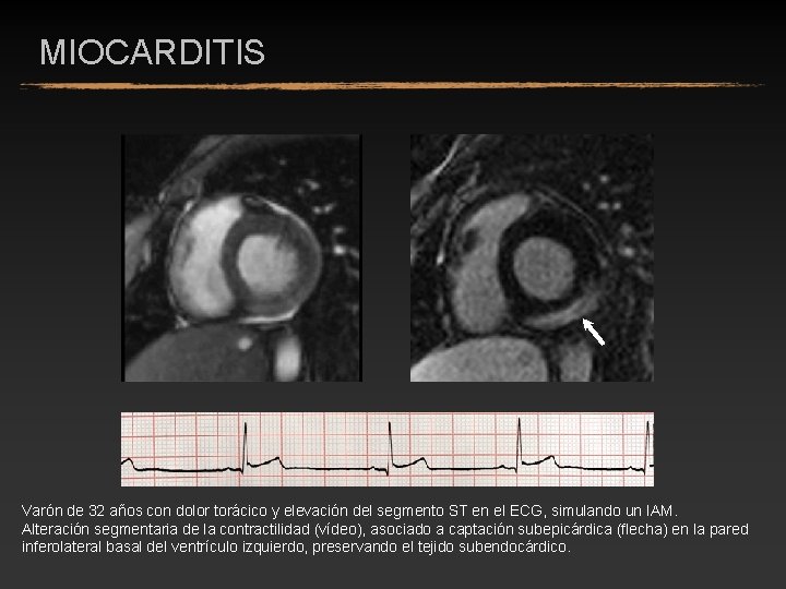 MIOCARDITIS Varón de 32 años con dolor torácico y elevación del segmento ST en