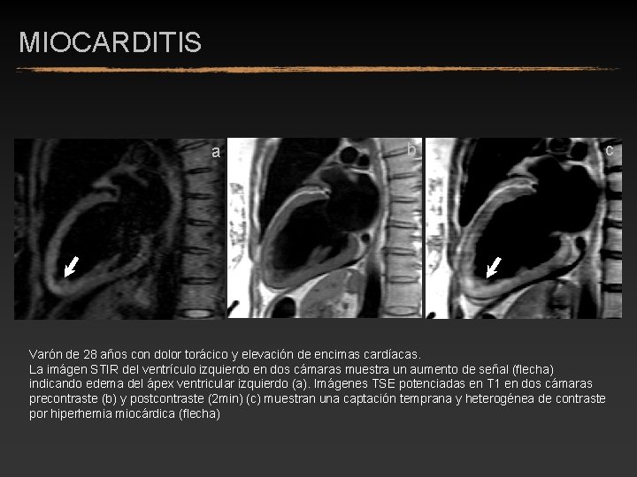 MIOCARDITIS a b c Varón de 28 años con dolor torácico y elevación de