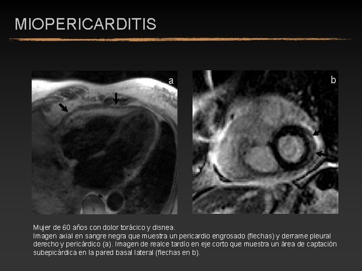 MIOPERICARDITIS a b Mujer de 60 años con dolor torácico y disnea. Imagen axial