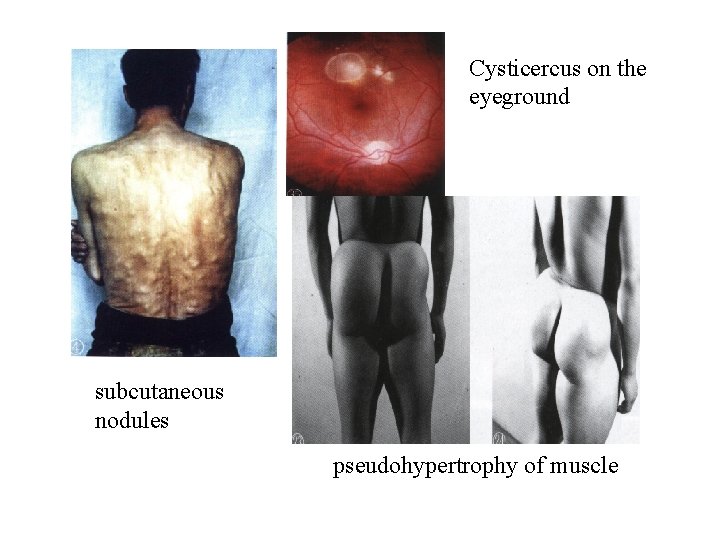 Cysticercus on the eyeground subcutaneous nodules pseudohypertrophy of muscle Cysticercus on the eyeground subcutaneous nodules pseudohypertrophy of muscle